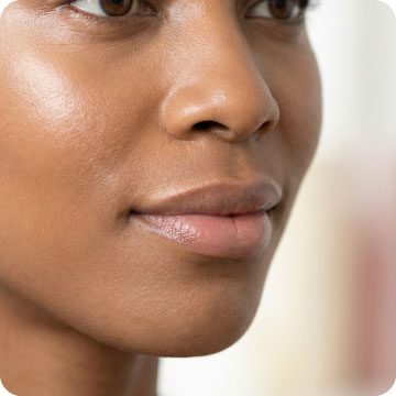 Mapping and placement plan for dermal filler treatment at Alexis Aesthetics